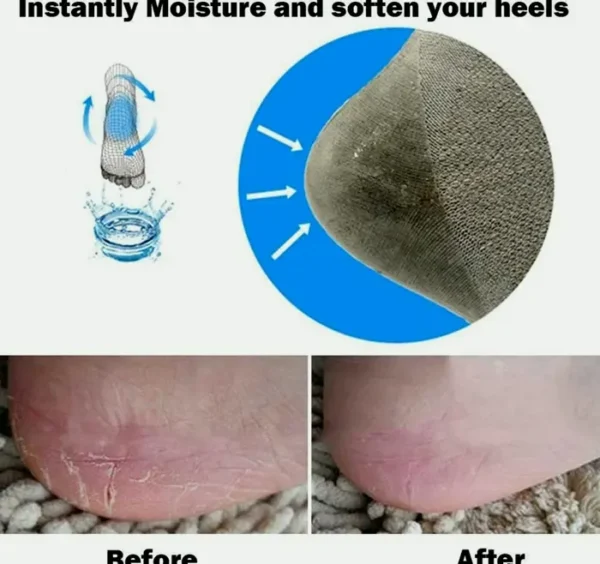 Ultimate Cracked Foot Treatment Gel Socks Bundle